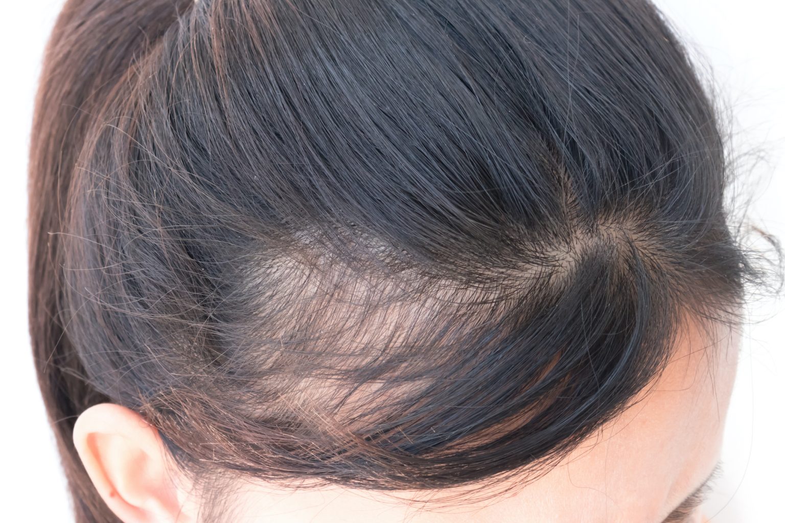 Female Nutritional Deficiencies And Hair Loss